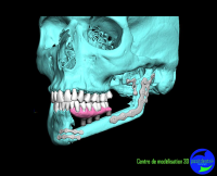 Modélisation 3D et reconstruction maxillofaciale