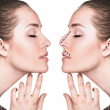 La rhinoplastie