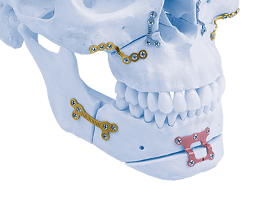 La Chirurgie Orthognathique est un acte spécifique de la Chirurgie Maxillofaciale.